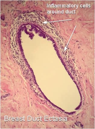 Sometimes duct ectasia causes