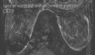 dcis mri
