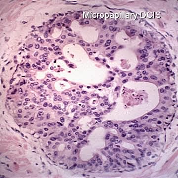 micropapillary dcis