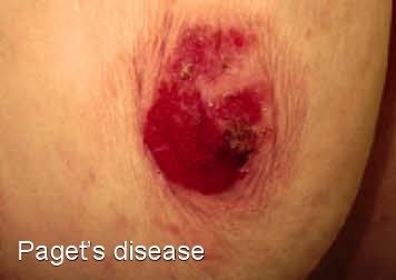 bloody nipple discharge.